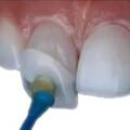 “Veneers in India vs UAE: Why International Patients Are Choosing India for Their Dream Smile”
