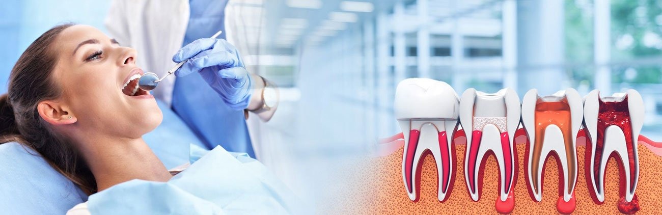 Root Canal Theraphy