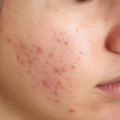 Advanced Acne Treatment in India | Expert Skin Care Solutions for Clear Skin